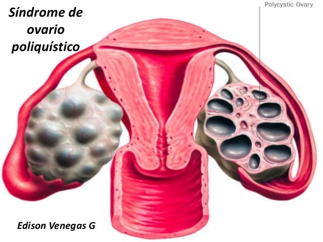 Síndrome De Ovario Poliquísticos Sanidades El Portal De Salud De España 8003